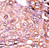 EP300 / p300 Antibody - Formalin-fixed and paraffin-embedded human cancer tissue reacted with the primary antibody, which was peroxidase-conjugated to the secondary antibody, followed by AEC staining. This data demonstrates the use of this antibody for immunohistochemistry; clinical relevance has not been evaluated. BC = breast carcinoma; HC = hepatocarcinoma.