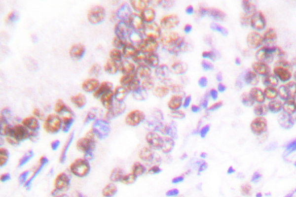 EP300 / p300 Antibody - IHC of p300 (V6) pAb in paraffin-embedded human lung carcinoma tissue.