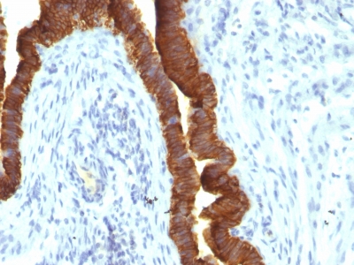 EPCAM Antibody - Formalin-fixed, paraffin-embedded Human Ovarian Carcinoma stained with EpCAM Mouse Recombinant Monoclonal Antibody (rEGP40/1110).