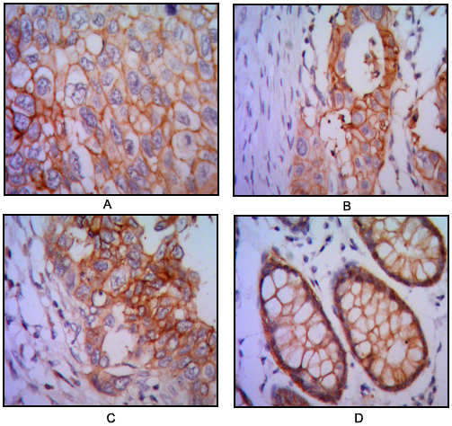EPCAM Antibody - IHC of paraffin-embedded human lung cancer (A), colon cancer (B), breast cancer (C) and rectal cancer(D), using EPCAM mouse monoclonal antibody with DAB staining.