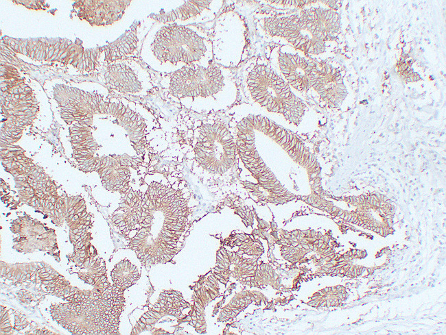 EPCAM Antibody - Colon Carcinoma 1
