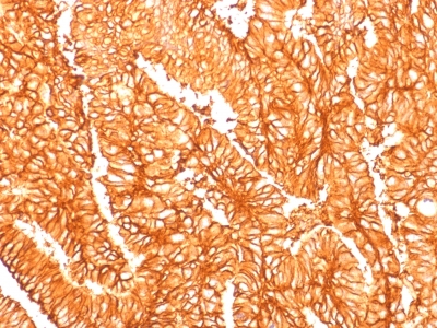 EPCAM Antibody - Formalin-fixed, paraffin-embedded human Colon Carcinoma stained with EpCAM Rabbit Recombinant Monoclonal Antibody (EGP40/1556R).