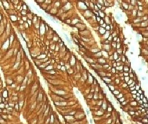 EPCAM Antibody - IHC testing of FFPE human colon carcinoma and EpCAM antibody (EPM17-1).  This image was taken for the unmodified form of this product. Other forms have not been tested.