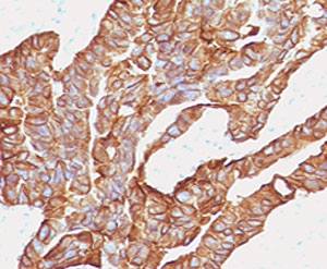 EPCAM Antibody - IHC testing of human colorectal carcinoma with anti-EpCAM antibody (clone EPM17-2).