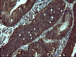 EPCAM Antibody - IHC of paraffin-embedded Carcinoma of Human pancreas tissue using anti-EPCAM mouse monoclonal antibody.