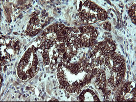EPCAM Antibody - IHC of paraffin-embedded Carcinoma of Human prostate tissue using anti-EPCAM mouse monoclonal antibody.