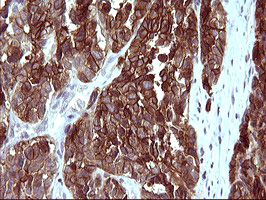 EPCAM Antibody - IHC of paraffin-embedded Adenocarcinoma of Human colon tissue using anti-EPCAM mouse monoclonal antibody. (Heat-induced epitope retrieval by 10mM citric buffer, pH6.0, 120°C for 3min).