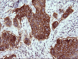 EPCAM Antibody - IHC of paraffin-embedded Carcinoma of Human lung tissue using anti-EPCAM mouse monoclonal antibody. (Heat-induced epitope retrieval by 10mM citric buffer, pH6.0, 120°C for 3min).