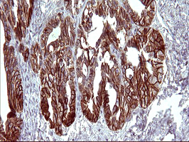 EPCAM Antibody - IHC of paraffin-embedded Adenocarcinoma of Human ovary tissue using anti-EPCAM mouse monoclonal antibody. (Heat-induced epitope retrieval by 10mM citric buffer, pH6.0, 120°C for 3min).