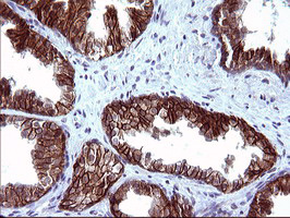 EPCAM Antibody - IHC of paraffin-embedded Carcinoma of Human prostate tissue using anti-EPCAM mouse monoclonal antibody. (Heat-induced epitope retrieval by 10mM citric buffer, pH6.0, 120°C for 3min).