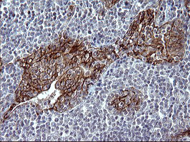 EPCAM Antibody - IHC of paraffin-embedded Human lymphoma tissue using anti-EPCAM mouse monoclonal antibody. (Heat-induced epitope retrieval by 10mM citric buffer, pH6.0, 120°C for 3min).