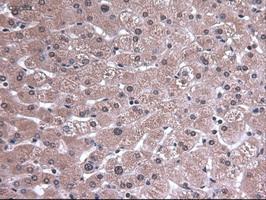 EPCAM Antibody - IHC of paraffin-embedded Carcinoma of lung using anti-EpCAM mouse monoclonal antibody.