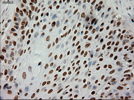EPCAM Antibody - IHC of paraffin-embedded Carcinoma of lung using anti-EpCAM mouse monoclonal antibody.