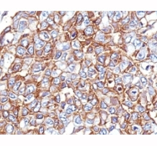 EPCAM Antibody - Formalin-fixed, paraffin-embedded human breast carcinoma stained with EpCAM antibody (PAN-EpCAM).  This image was taken for the unmodified form of this product. Other forms have not been tested.