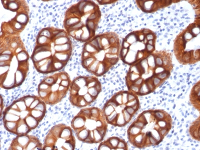 EPCAM Antibody - Formalin-fixed, paraffin-embedded Human Colon Carcinoma stained with EpCAM Mouse Recombinant Monoclonal Antibody (rMOC-31).