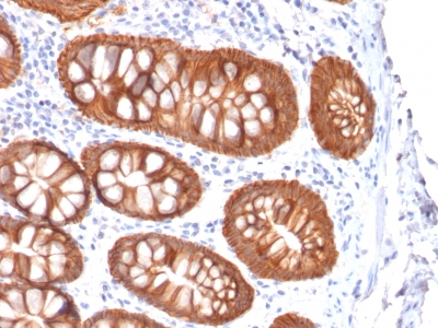 EPCAM Antibody - Formalin-fixed, paraffin-embedded human Colon Carcinoma stained with EpCAM Mouse Recombinant Monoclonal Antibody (rVU-1D9).
