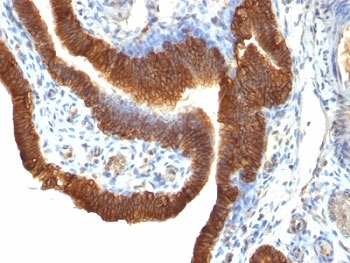 EPCAM Antibody - Formalin-fixed, paraffin-embedded human ovarian carcinoma stained with EpCAM antibody (SPM491).  This image was taken for the unmodified form of this product. Other forms have not been tested.