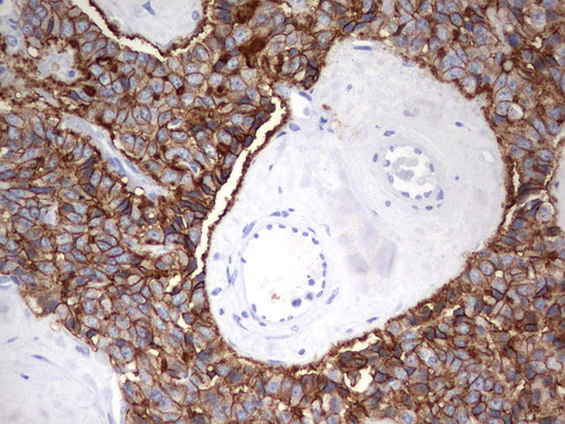EPCAM Antibody - Immunohistochemical staining of paraffin-embedded Carcinoma of Human pancreas tissue using anti-EPCAM mouse monoclonal antibody.  heat-induced epitope retrieval by 10mM citric buffer, pH6.0, 120C for 3min)