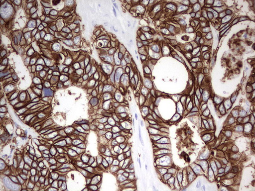 EPCAM Antibody - Immunohistochemical staining of paraffin-embedded Adenocarcinoma of Human colon tissue using anti-EPCAM mouse monoclonal antibody.  heat-induced epitope retrieval by 10mM citric buffer, pH6.0, 120C for 3min)