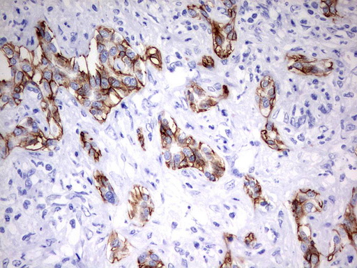 EPCAM Antibody - Immunohistochemical staining of paraffin-embedded Carcinoma of Human liver tissue using anti-EPCAM mouse monoclonal antibody.  heat-induced epitope retrieval by 10mM citric buffer, pH6.0, 120C for 3min)
