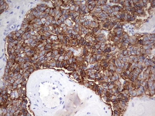EPCAM Antibody - Immunohistochemical staining of paraffin-embedded Carcinoma of Human pancreas tissue using anti-EPCAMEPCAMmonoclonal antibody.  heat-induced epitope retrieval by 10mM citric buffer, pH6.0, 120C for 3min)