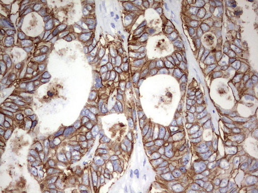 EPCAM Antibody - Immunohistochemical staining of paraffin-embedded Adenocarcinoma of Human colon tissue using anti-EPCAM mouse monoclonal antibody.  heat-induced epitope retrieval by 10mM citric buffer, pH6.0, 120C for 3min)