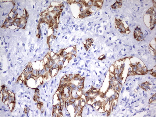 EPCAM Antibody - Immunohistochemical staining of paraffin-embedded Carcinoma of Human liver tissue using anti-EPCAMmouse monoclonal antibody.  heat-induced epitope retrieval by 10mM citric buffer, pH6.0, 120C for 3min)