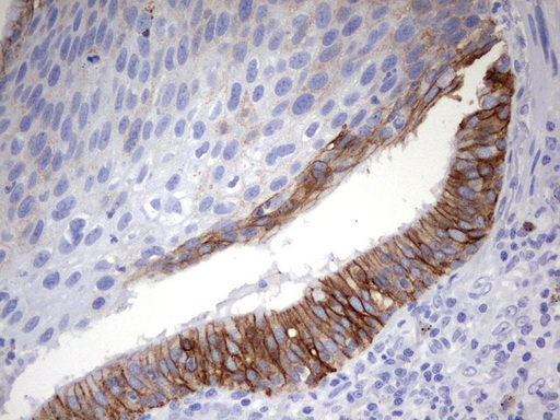 EPCAM Antibody - Immunohistochemical staining of paraffin-embedded Carcinoma of Human lung tissue using anti-EPCAMmouse monoclonal antibody.  heat-induced epitope retrieval by 10mM citric buffer, pH6.0, 120C for 3min)