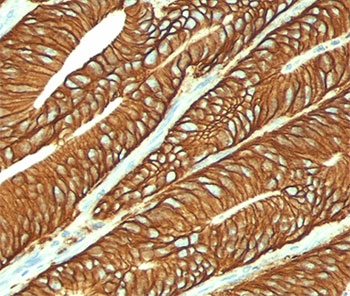 EPCAM Antibody - EpCAM antibody VU-1D9 immunohistochemistry colon cancer.  This image was taken for the unmodified form of this product. Other forms have not been tested.