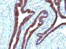 EPCAM Antibody - Formalin-fixed, paraffin-embedded human ovarian carcinoma stained with EpCAM antibody (EGP40/1110).  This image was taken for the unmodified form of this product. Other forms have not been tested.