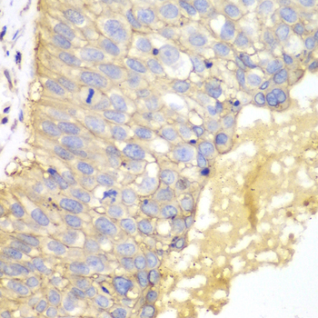 EPCAM Antibody - Immunohistochemistry of paraffin-embedded human lung cancer using EPCAM antibodyat dilution of 1:100 (40x lens).