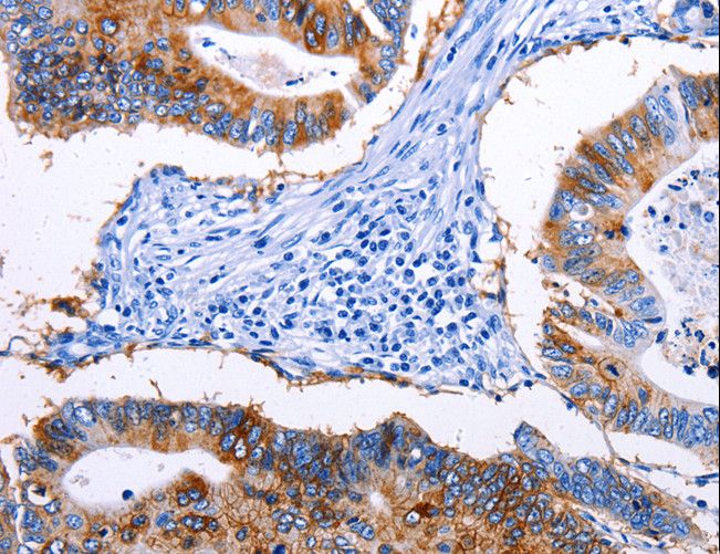 EPCAM Antibody - Immunohistochemistry of paraffin-embedded Human colon cancer using EPCAM Polyclonal Antibody at dilution of 1:45.