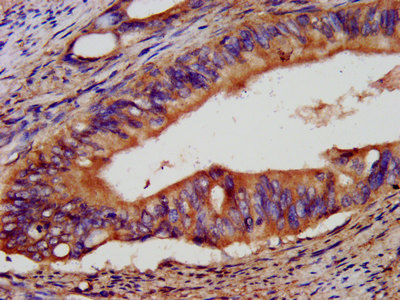EPCAM Antibody - Immunohistochemistry image at a dilution of 1:400 and staining in paraffin-embedded human colon cancer performed on a Leica BondTM system. After dewaxing and hydration, antigen retrieval was mediated by high pressure in a citrate buffer (pH 6.0) . Section was blocked with 10% normal goat serum 30min at RT. Then primary antibody (1% BSA) was incubated at 4 °C overnight. The primary is detected by a biotinylated secondary antibody and visualized using an HRP conjugated SP system.