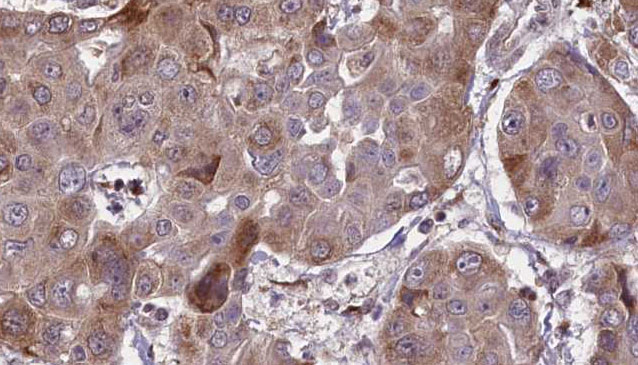 EPCAM Antibody - 1:100 staining human liver carcinoma tissues by IHC-P. The sample was formaldehyde fixed and a heat mediated antigen retrieval step in citrate buffer was performed. The sample was then blocked and incubated with the antibody for 1.5 hours at 22°C. An HRP conjugated goat anti-rabbit antibody was used as the secondary.