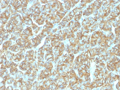 EPCAM Antibody - Formalin-fixed, paraffin-embedded human Thyroid Carcinoma stained with EpCAM Rabbit Recombinant Monoclonal Antibody (EGP40/1555R).