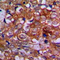 EPHA1 / EPH Receptor A1 Antibody - Immunohistochemical analysis of EPHA1 staining in human prostate cancer formalin fixed paraffin embedded tissue section. The section was pre-treated using heat mediated antigen retrieval with sodium citrate buffer (pH 6.0). The section was then incubated with the antibody at room temperature and detected with HRP and DAB as chromogen. The section was then counterstained with hematoxylin and mounted with DPX.