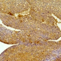 EPHA1 / EPH Receptor A1 Antibody - Immunohistochemical analysis of EPHA1 staining in human Hepatocarcinoma;human breast cancer formalin fixed paraffin embedded tissue section. The section was pre-treated using heat mediated antigen retrieval with sodium citrate buffer (pH 6.0). The section was then incubated with the antibody at room temperature and detected using an HRP conjugated compact polymer system. DAB was used as the chromogen. The section was then counterstained with hematoxylin and mounted with DPX.