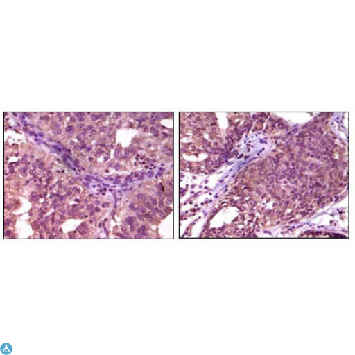 EPHA1 / EPH Receptor A1 Antibody - Immunohistochemistry (IHC) analysis of paraffin-embedded Human Ovary carcinoma (left) and breast carcinoma (right), showing cytoplasmic localization with DAB staining using EphA1 Monoclonal Antibody.