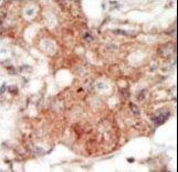 EPHA4 / EPH Receptor A4 Antibody - Formalin-fixed and paraffin-embedded human cancer tissue reacted with the primary antibody, which was peroxidase-conjugated to the secondary antibody, followed by DAB staining. This data demonstrates the use of this antibody for immunohistochemistry; clinical relevance has not been evaluated. BC = breast carcinoma; HC = hepatocarcinoma.