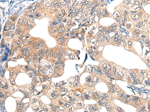 EPHA6 / EPH Receptor A6 Antibody - Immunohistochemistry of paraffin-embedded Human gastric cancer tissue  using EPHA6 Polyclonal Antibody at dilution of 1:40(×200)