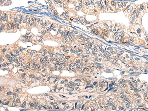 EPHA6 / EPH Receptor A6 Antibody - Immunohistochemistry of paraffin-embedded Human gastric cancer tissue  using EPHA6 Polyclonal Antibody at dilution of 1:25(×200)