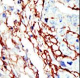 EPHA7 / EPH Receptor A7 Antibody - Formalin-fixed and paraffin-embedded human cancer tissue reacted with the primary antibody, which was peroxidase-conjugated to the secondary antibody, followed by AEC staining. This data demonstrates the use of this antibody for immunohistochemistry; clinical relevance has not been evaluated. BC = breast carcinoma; HC = hepatocarcinoma.