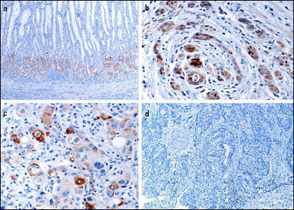 EPHB1 / EPH Receptor B1 Antibody - Immunohistochemical of EphB1 in gastric cancer tissues. a EphB1 protein expressed in normal mucosa at the glandular compartment and in a decreasing gradient from the glandular compartment to the foveolar compartment. b EphB1 protein focally positively stained in well-differentiated gastric cancer cells. c EphB1 protein is focally positive in poorly differentiated gastric cancer cells. d Loss of EphB1 expression in gastric cancer cells.(Provided by Jian-dong Wang,Department of Pathology Nanjing Jinling Hospital/Nanjing University School of Medicine)