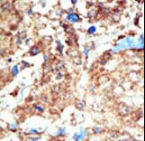 EPHB1 / EPH Receptor B1 Antibody - Formalin-fixed and paraffin-embedded human cancer tissue reacted with the primary antibody, which was peroxidase-conjugated to the secondary antibody, followed by DAB staining. This data demonstrates the use of this antibody for immunohistochemistry; clinical relevance has not been evaluated. BC = breast carcinoma; HC = hepatocarcinoma.