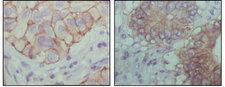 EPHB1 / EPH Receptor B1 Antibody - IHC of paraffin-embedded human lung cancer (left) and colon cancer (right) showing cytoplasmic localization with DAB staining using EphB1 mouse monoclonal antibody.