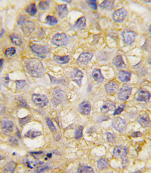 EPHB2 / EPH Receptor B2 Antibody - Formalin-fixed and paraffin-embedded human breast carcinoma tissue reacted with EphB2 antibody , which was peroxidase-conjugated to the secondary antibody, followed by DAB staining. This data demonstrates the use of this antibody for immunohistochemistry; clinical relevance has not been evaluated.