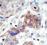 EPHB3 / EPH Receptor B3 Antibody - Formalin-fixed and paraffin-embedded human cancer tissue reacted with the primary antibody, which was peroxidase-conjugated to the secondary antibody, followed by DAB staining. This data demonstrates the use of this antibody for immunohistochemistry; clinical relevance has not been evaluated. BC = breast carcinoma; HC = hepatocarcinoma.