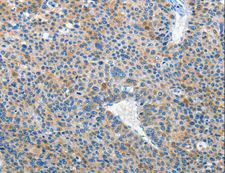 EPHB3 / EPH Receptor B3 Antibody - Immunohistochemistry of paraffin-embedded Human liver cancer using EPHB3 Polyclonal Antibody at dilution of 1:50.