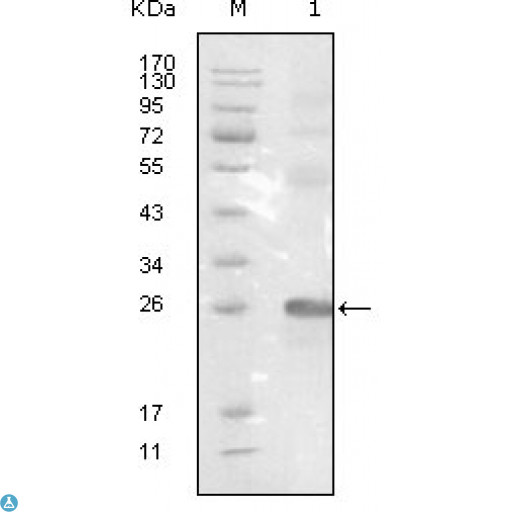 EPHB3 / EPH Receptor B3 Antibody - Immunohistochemistry (IHC) analysis of paraffin-embedded Human Lung squamous cell carcinoma (A), lung adenocarcinoma (B), colon carcinoma (C), breast carcinoma (D), normal sublingual gland (E), normal rectal (F), showing membrane localization with DAB staining.