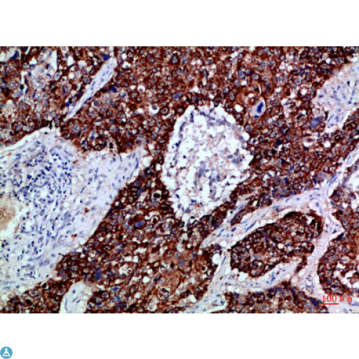 EPHB3 / EPH Receptor B3 Antibody - Immunohistochemical analysis of paraffin-embedded human-lung-cancer, antibody was diluted at 1:100.